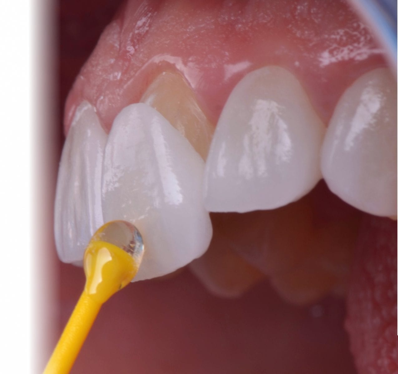 Smile Design by Dental Veneers